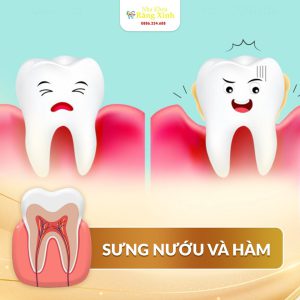 Sưng Nượu gây đau nhức khi ăn nhai