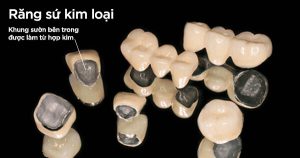 răng sứ kim loại thường