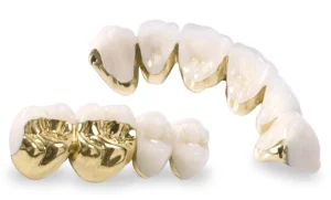răng sứ kim loại quý mạ vàng