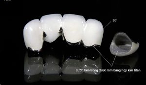 Răng sứ titan