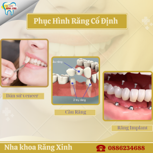 Phục hình răng cố định tại nha khoa răng xinh