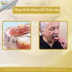 Phục hình răng tháo lắp
