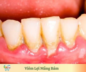 viêm lợi mảng bám