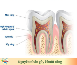 nguyên nhân gây ê buốt răng