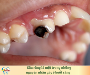 sâu răng là một trong những nguyên gây ê buốt răng