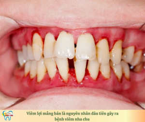viêm lợi là nguyên nhân đầu tiên gây ra bệnh viêm nha chu