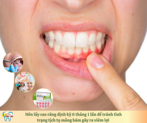 nên lấy cao răng định kỳ 6 tháng 1 lần để tránh tình trạng tích tụ mảng bám gây ra viêm lợi