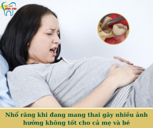 Nhổ răng khi đang mang thai gây nhiều ảnh hưởng không tốt cho cả mẹ và bé