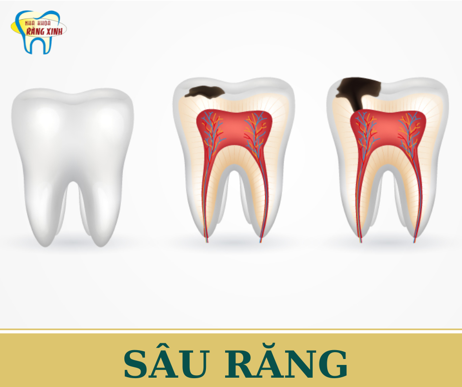 SÂU RĂNG - NGUYÊN NHÂN, DẤU HIỆU VÀ CÁCH ĐIỀU TRỊ HIỆU QUẢ
