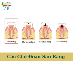 các giai đoạn sâu răng