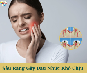 sâu răng gây đau nhức khó chịu