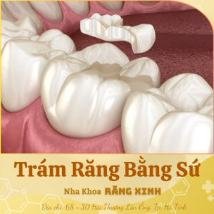 Trám răng bằng sứ