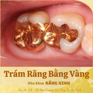 Trám răng bằng vàng