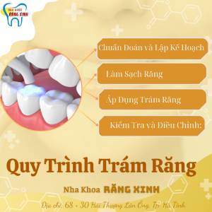 Quy trình trám răng