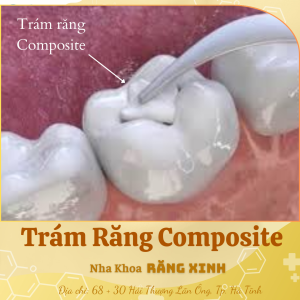 Trám răng Composite