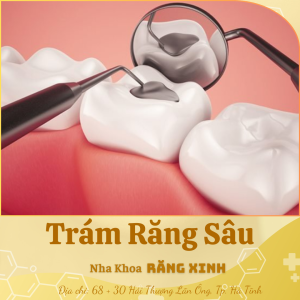 Trám răng sâu