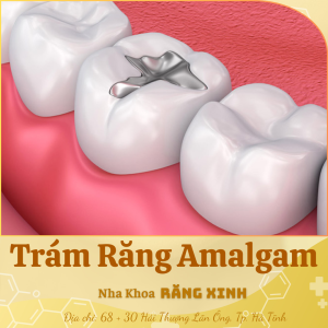 Trám răng Amalgam