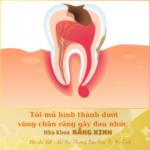 Túi mủ hình thành dưới vùng chân răng gây đau nhức