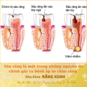 Sâu răng là một trong những nguyên do chính gây ra bệnh áp xe răng