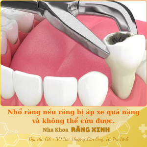 Nhổ răng nếu răng bị áp xe quá nặng và không thể cứu được