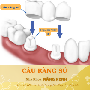 cầu răng sứ