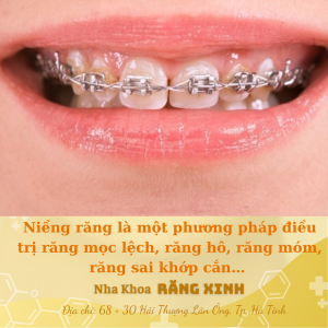 Niềng răng là một phương pháp điều trị răng mọc lệch, răng hô, răng móm, răng sai khớp cắn…
