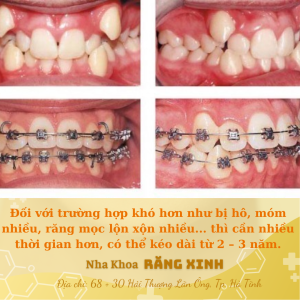 Đối với trường hợp khó hơn như bị hô, móm nhiều, răng mọc lộn xộn nhiều... thì cần nhiều thời gian hơn, có thể kéo dài từ 2 – 3 năm.