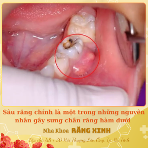 Sâu răng chính là nguyên nhân gây sưng chân răng hàm dưới