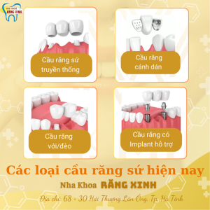 các loại cầu răng sứ hiện nay.