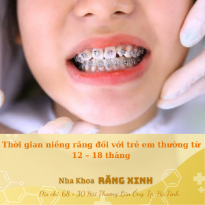 Thời gian niềng răng đối với trẻ em thường từ 12 – 18 tháng