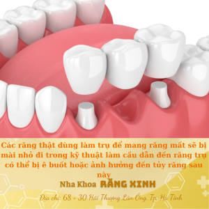 Các răng thật dùng làm trụ để mang răng mất sẽ bị mài nhỏ đi trong kỹ thuật làm cầu dẫn đến răng trụ có thể bị ê buốt hoặc ảnh hưởng đến tủy răng sau này