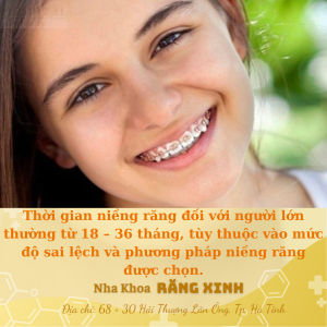 Thời gian niềng răng đối với người lớn thường từ 18 – 36 tháng, tùy thuộc vào mức độ sai lệch và phương pháp niềng răng được chọn