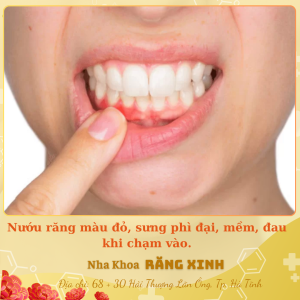 Nướu răng màu đỏ, sưng phì đại, mềm, đau khi chạm vào.