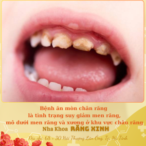 Bệnh ăn mòn chân răng là tình trạng suy giảm men răng, mô dưới men răng và xương ở khu vực chân răng