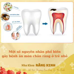 Một số nguyên nhân gây bệnh ăn mòn chân răng ở trẻ nhỏ
