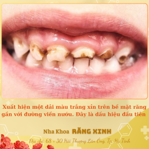 Xuất hiện một dải màu trắng xỉn trên bề mặt răng gần với đường viền nướu. Đây là dấu hiệu đầu tiên