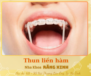 Thun liền hàm