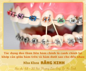Tác dụng đeo thun liên hàm chính là canh chỉnh lại khớp cắn giữa hàm trên và hàm dưới sao cho đều nhau
