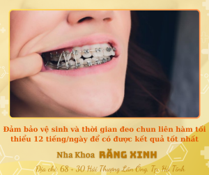 Đảm bảo vệ sinh và thời gian đeo chun liên hàm tối thiểu 12 tiếng/ngày để có được kết quả tốt nhất