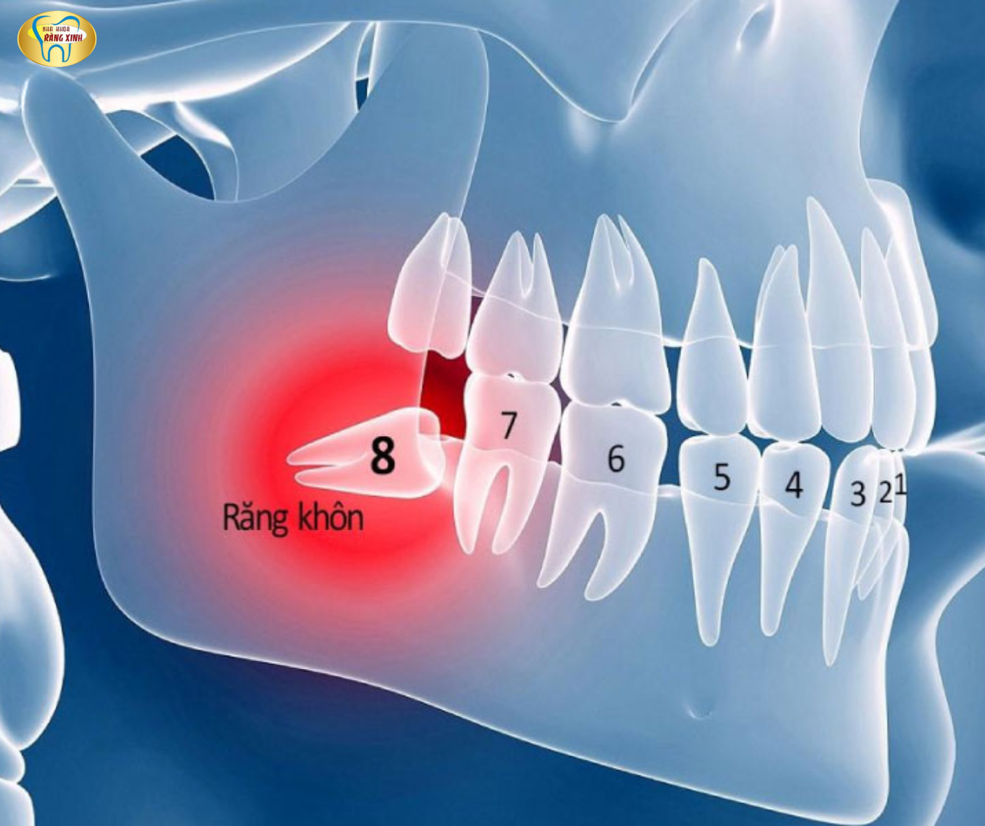 CÁC KIỂU RĂNG KHÔN MỌC LỆCH PHỔ BIẾN NHẤT.