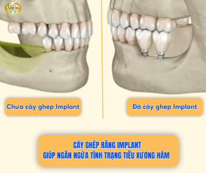 Cấy ghép răng implant giúp ngăn ngừa tình trạng tiêu xương hàm