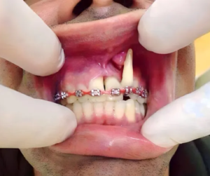 Đây là một tình trạng nghiêm trọng có thể xảy ra khi niềng răng không đúng kỹ thuật.