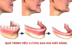 Sau khi mất răng, việc tiêu xương thường xảy ra từ tháng thứ 3 sau khi mất răng.