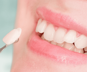 Ngoài việc thẩm mỹ, dán sứ Veneer còn giúp bảo tồn mô răng thật, kéo dài tuổi thọ cho răng.