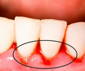 chảy máu chân răng thường xuyên chính là dấu hiệu bệnh lý bất thường, biểu hiện sớm của bệnh viêm nướu.