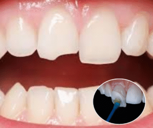 Dán sứ Veneer phù hợp với trường hợp sứt mẻ nhẹ, không quá 1/3 thân răng. Mặt dán sứ siêu mỏng từ 0.2 - 0.5mm.
