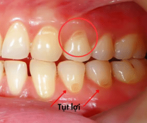 Ê buốt do tụt lợi ảnh hưởng rất lớn đến việc ăn nhai và sức khỏe tổng thể...