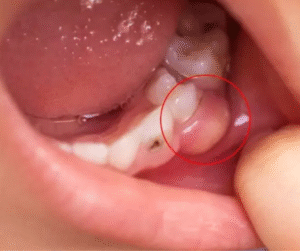 Đây là tình trạng nhiễm trùng cấp tính, có thể gây biến chứng lan rộng nếu không xử lý kịp thời, thậm chí đe dọa tính mạng trong một số trường hợp.