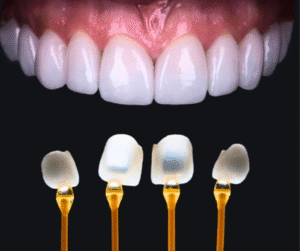 Dán sứ Veneer