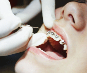 Sau khi tháo niềng thì nên làm gì để duy trì kết quả lâu dài..?